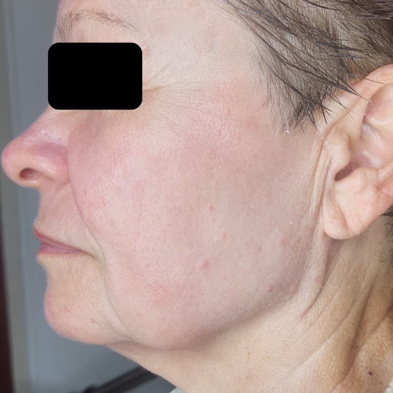 אחרי - חידוש והידוק מרקם עור