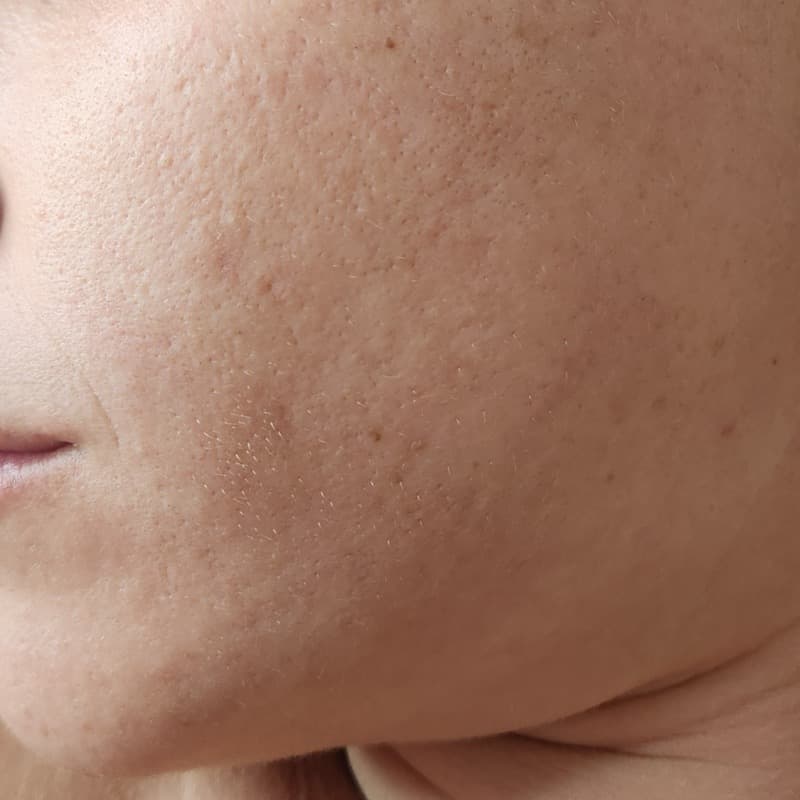 אחרי - אקנה וצלקות פוסט אקנה