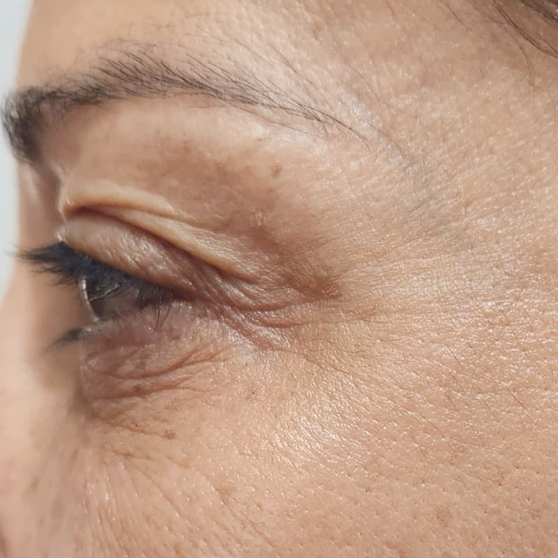 לפני - הרמת עפעף עליון