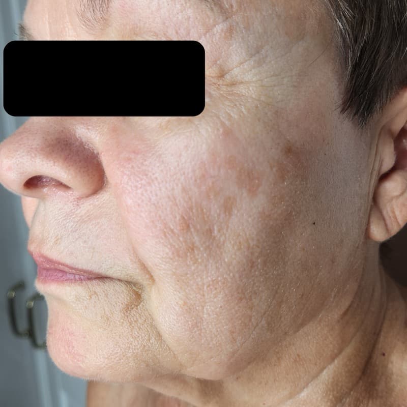 לפני - חידוש והידוק מרקם עור